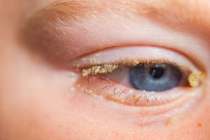 Vad ska du göra när ditt barn får ögoninflammation?